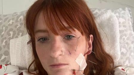 Femme Paralysie Faciale