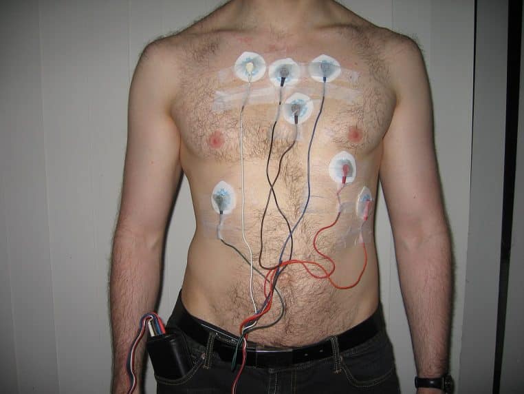 Électrodes et boîtier Holter posés sur le torse d’un patient pour une surveillance cardiaque ambulatoire.