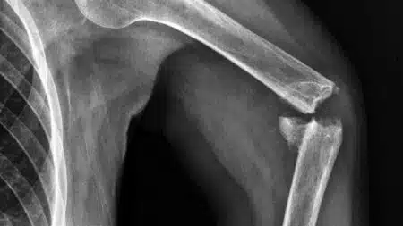 Os-Fracture-Adulte