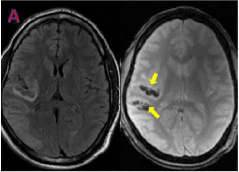 IRM T2* d’un infarctus cérébral