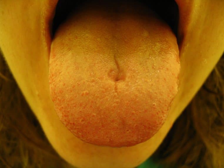 Cicatrice sur la face supérieure de la langue après piercing.