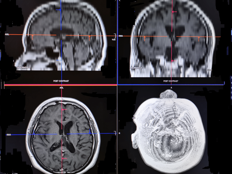 Coupe IRM T1 du cerveau en visualisation de travail ». Alt : « Planche d’IRM T1 du cerveau sur poste de lecture