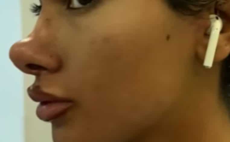 chirurgie esthétique nez Michael Jackson actu