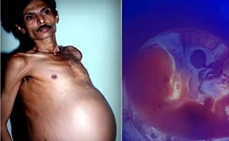 hôpital jumeau homme jumeaux actu