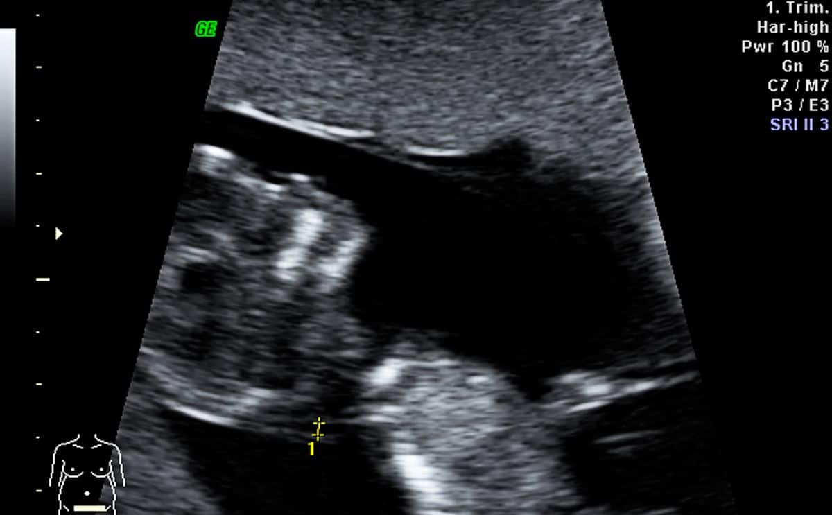 hôpital jumeau homme jumeaux actu