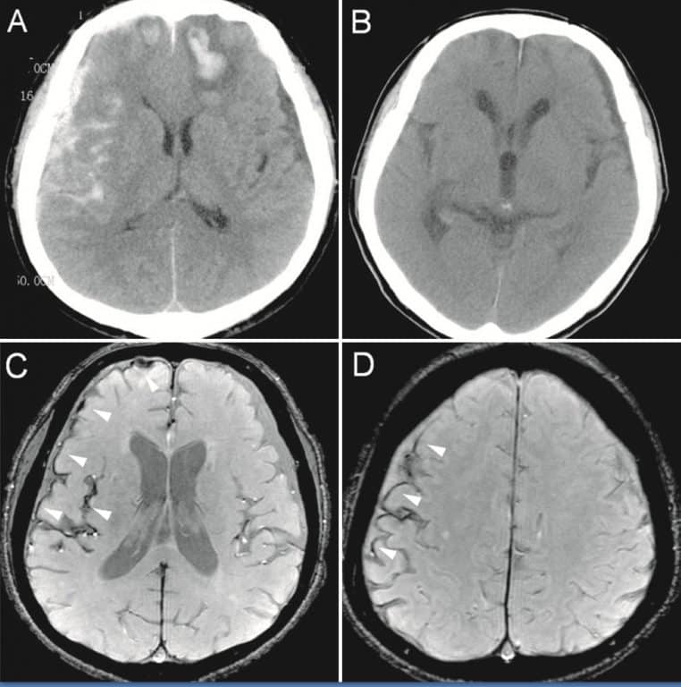 IRM axiale montrant un liseré d’hypo-intensité compatible avec dépôts d’hémosidérine après hémorragie intracrânienne.