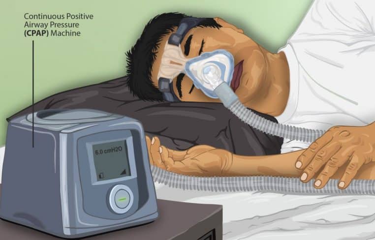 Patient allongé équipé d’un masque CPAP, tuyau relié à l’appareil, illustrant le traitement de l’apnée obstructive du sommeil.