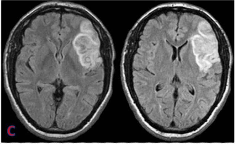 Coupe axiale IRM FLAIR du cerveau, montrant une lésion ischémique frontale avec hypersignal.