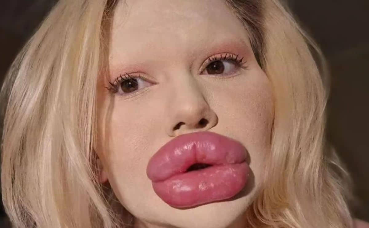 lèvres injections médecins