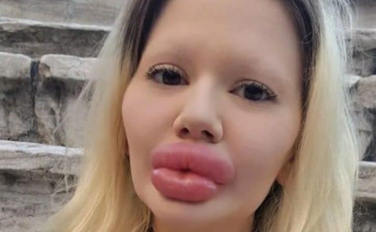 lèvres injections médecins