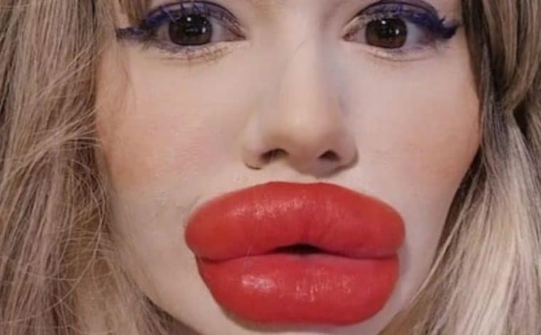 lèvres injections médecins