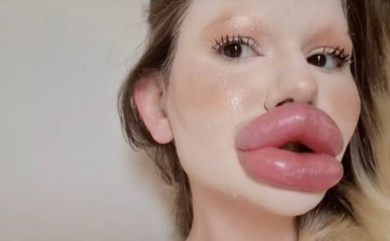 lèvres injections médecins