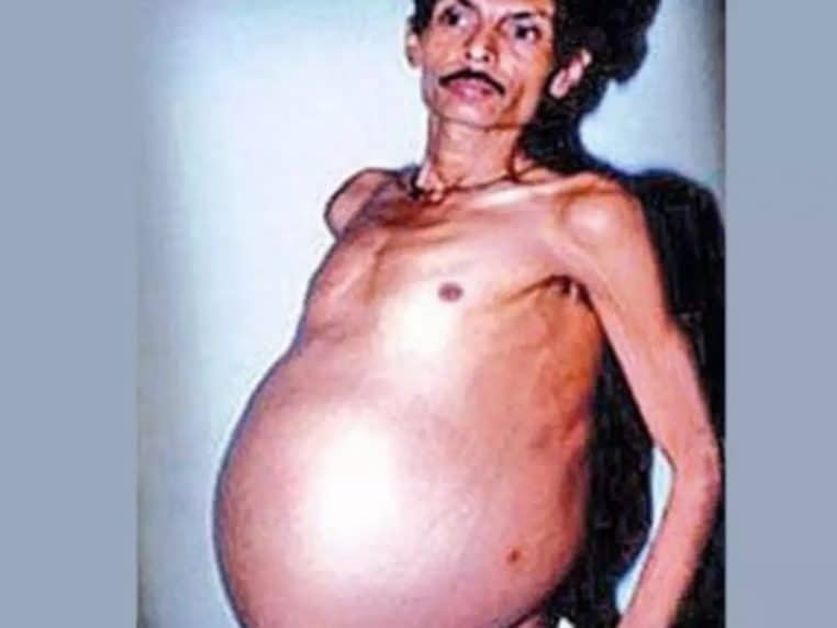 Homme avec ventre gonflé