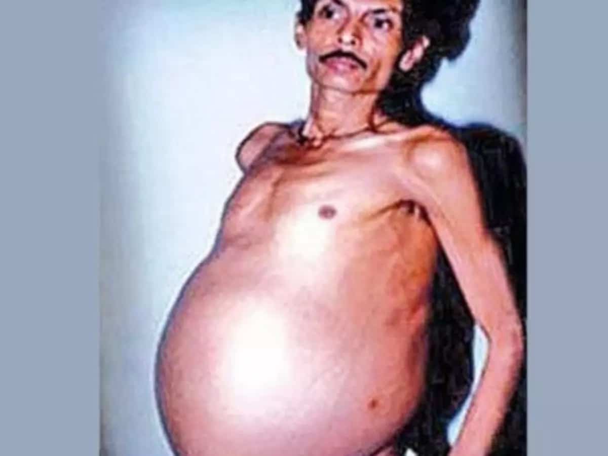 Homme avec ventre gonflé