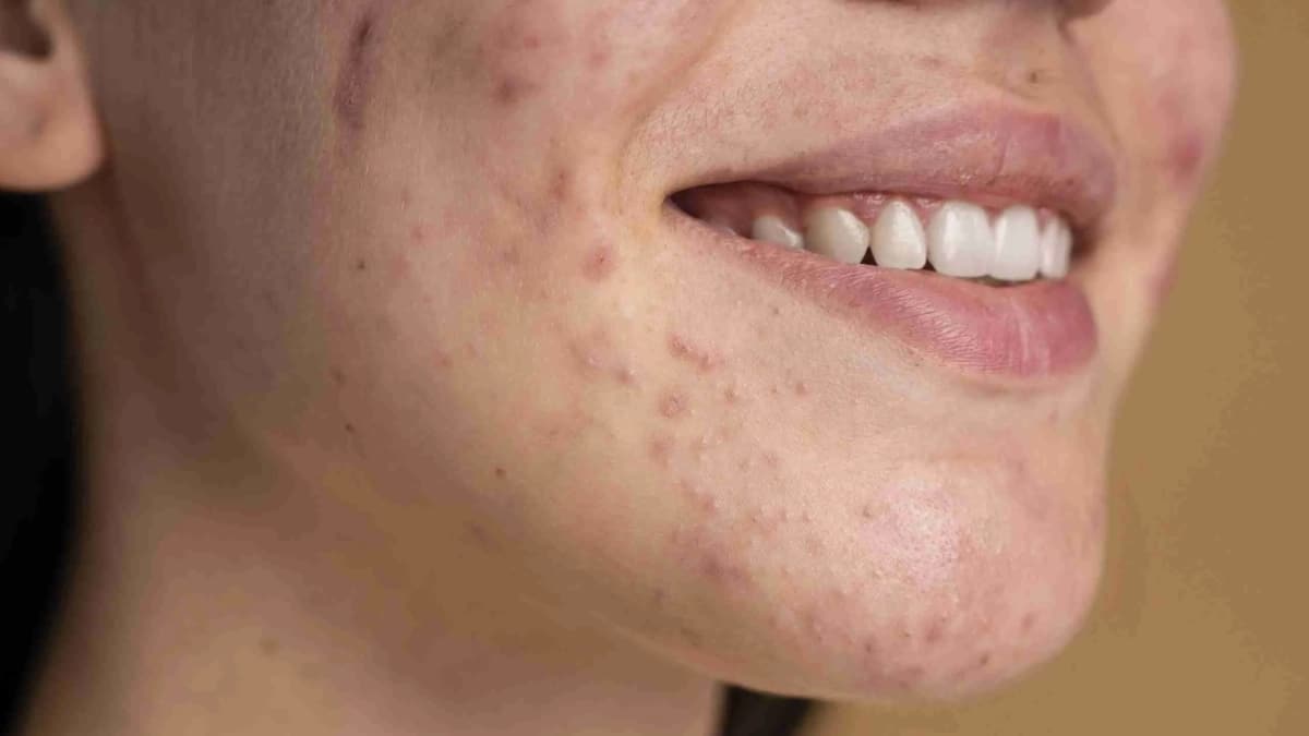 Boutons Visage Dangers