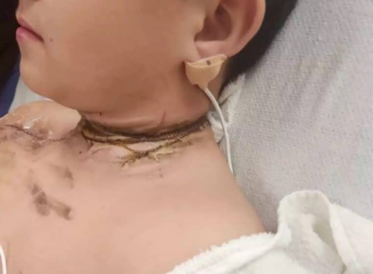 Cou garçon électrocuté