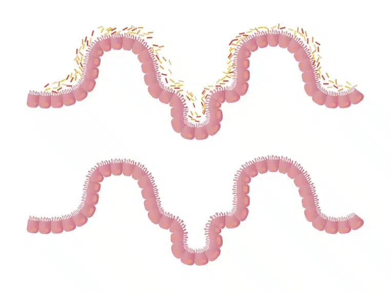 Illustration des villosités intestinales recouvertes de bactéries, comparant un intestin déséquilibré et un intestin plus sain sur fond blanc épuré.