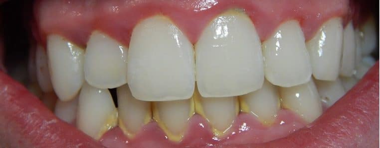 Gingivite avant traitement, gros plan sur inflammation gingivale et dépôts près du collet des dents.