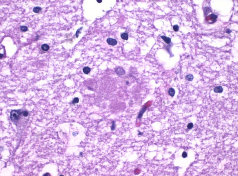 Micrographie d’une plaque amyloïde observée dans l’hippocampe, marqueur tissulaire lié à Alzheimer en histologie.