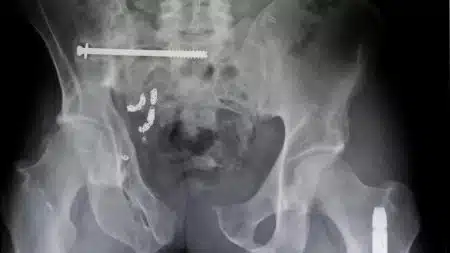 Rectum Objet Coince