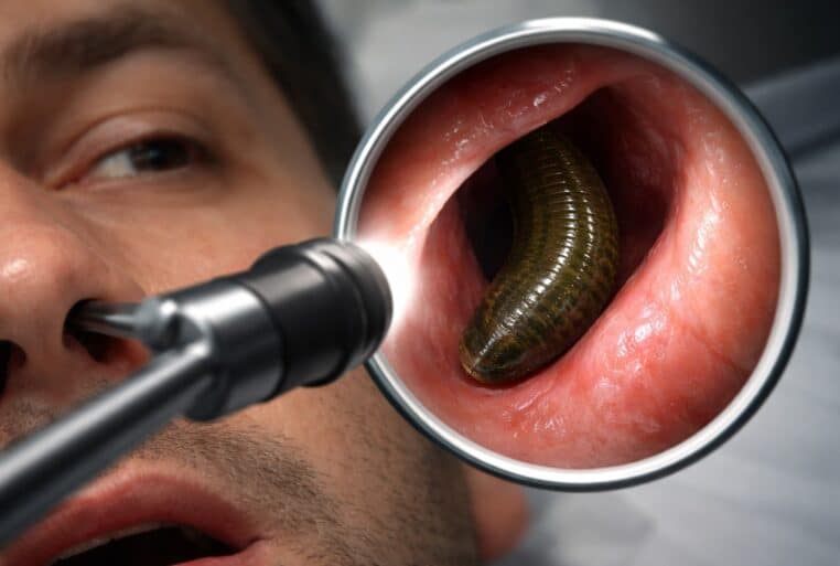 Endoscopie nasale : une sangsue vivante accrochée à l’intérieur d’une narine, cause de saignements prolongés.