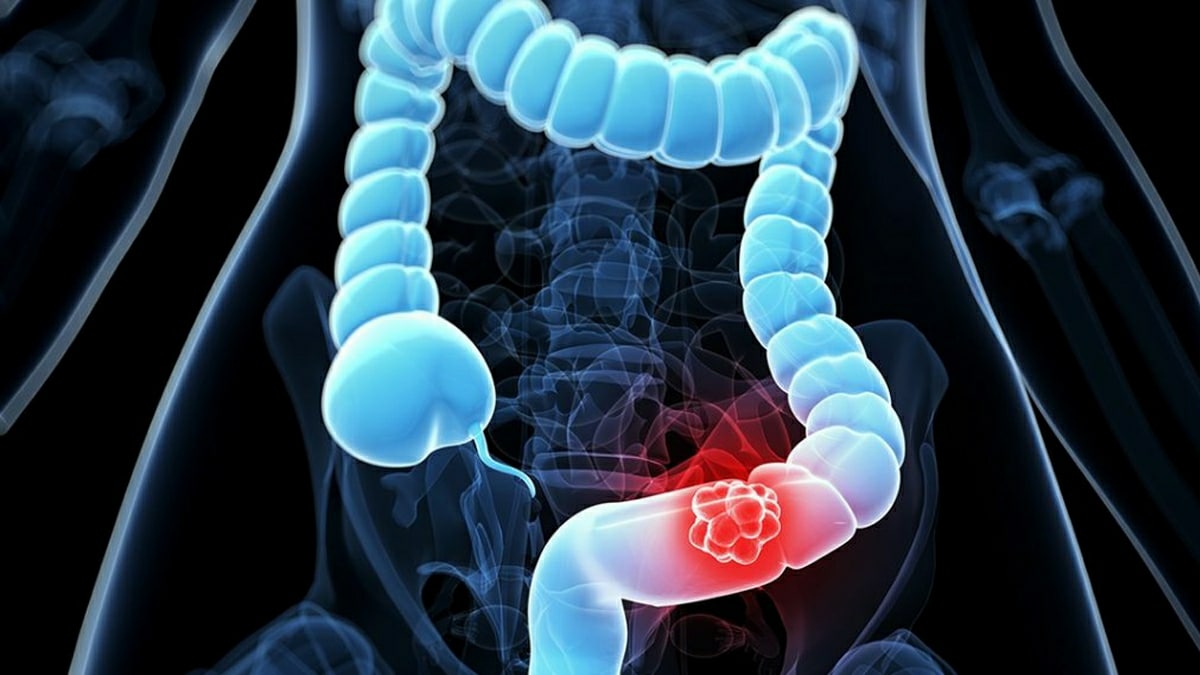 Cancer Colon Causes