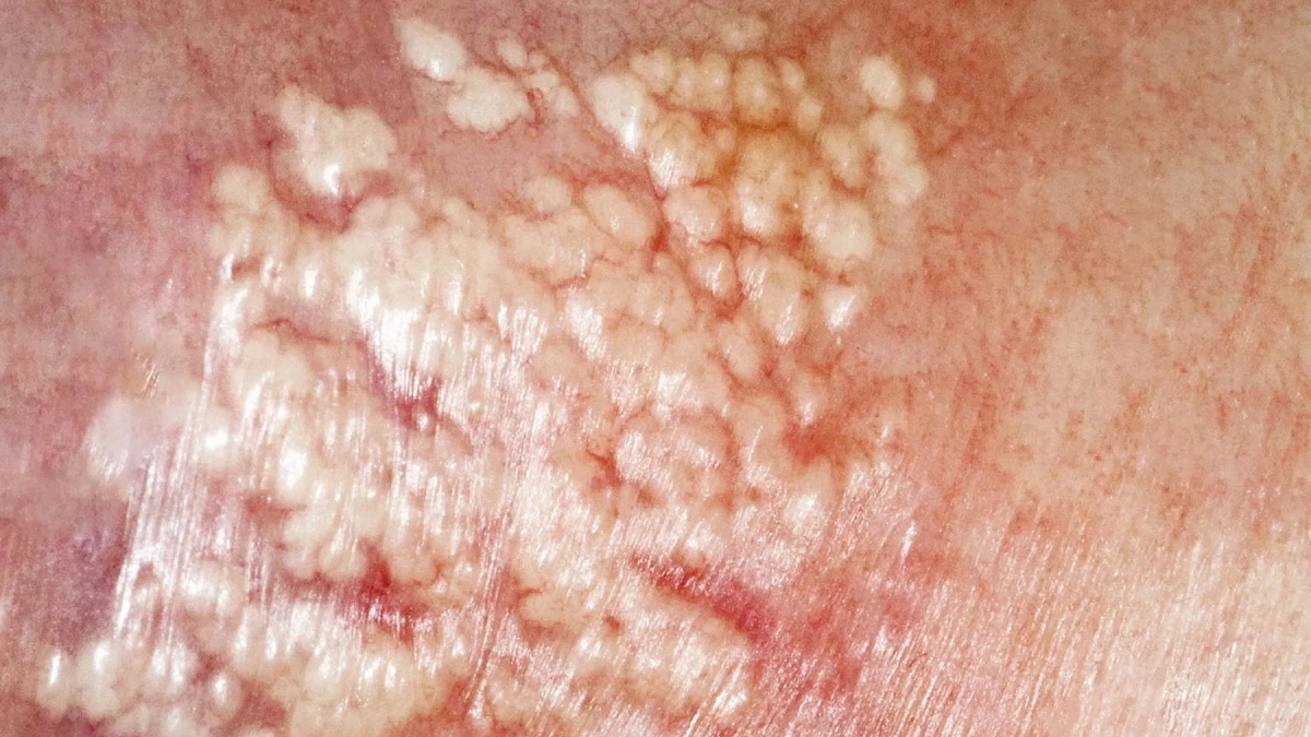 Taches Blanches Origines