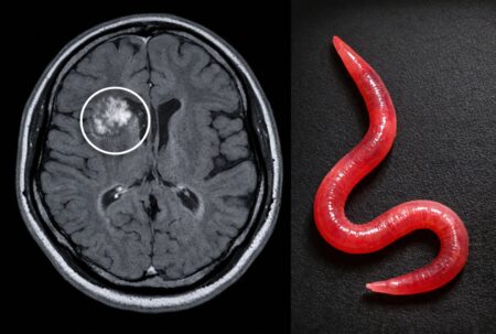 Larve dans le cerveau : IRM (radio) du cerveau avec zone suspecte, et gros plan d’une larve à droite.