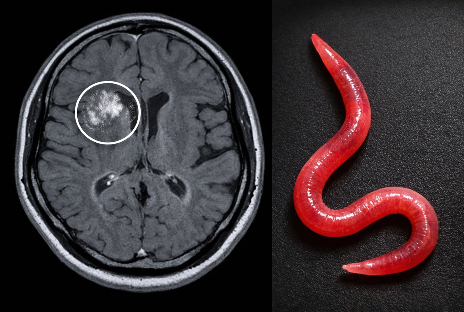Larve dans le cerveau : IRM (radio) du cerveau avec zone suspecte, et gros plan d’une larve à droite.