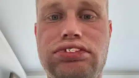 dents