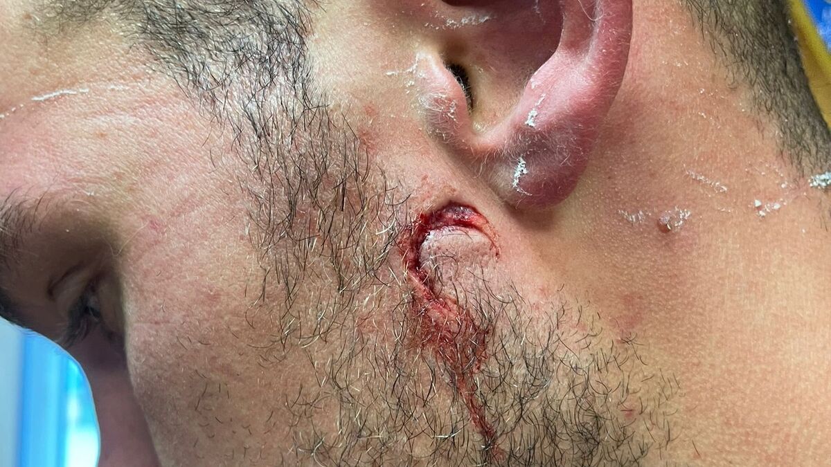 « Il me mord le visage, il avait du sang sur les dents » : un rugbyman raconte une agression en plein match de Fédérale 2