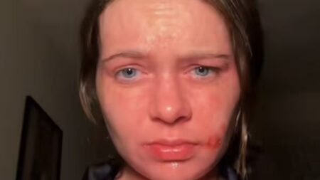 « Ma peau brûle en 15 secondes au soleil » : Jennifer, 24 ans, raconte sa vie avec cette allergie rare