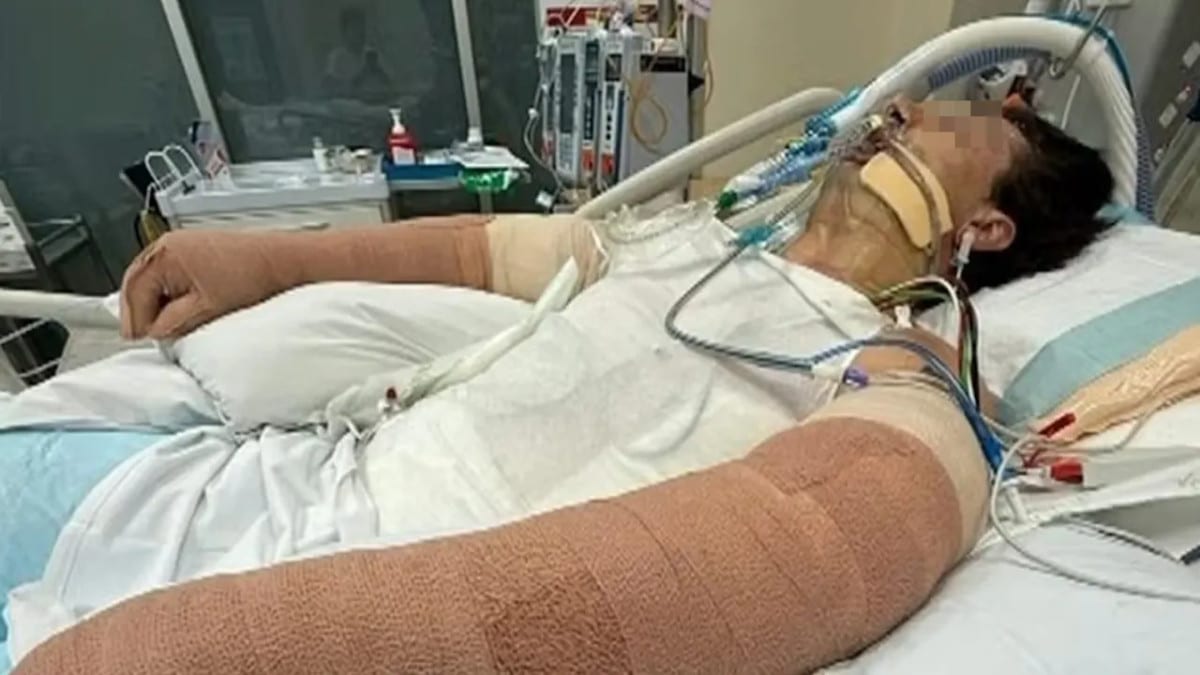 Il fait cuire son repas, son robot aspirateur explose et le laisse brûlé à 75%