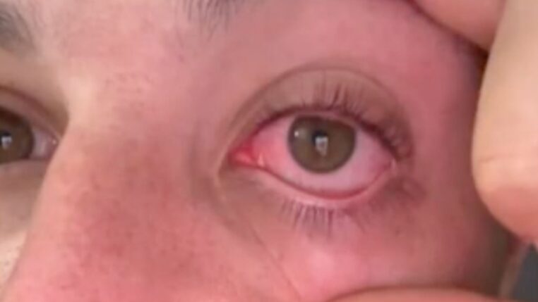 Éclipse solaire : un jeune homme aurait perdu la vue d&rsquo;un œil après avoir observé le phénomène sans protection (vidéo)