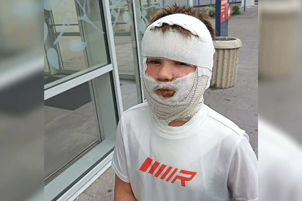 « La peau de ses lèvres se décollait » : ce jouet anti-stress vendu partout brûle un enfant de 8 ans