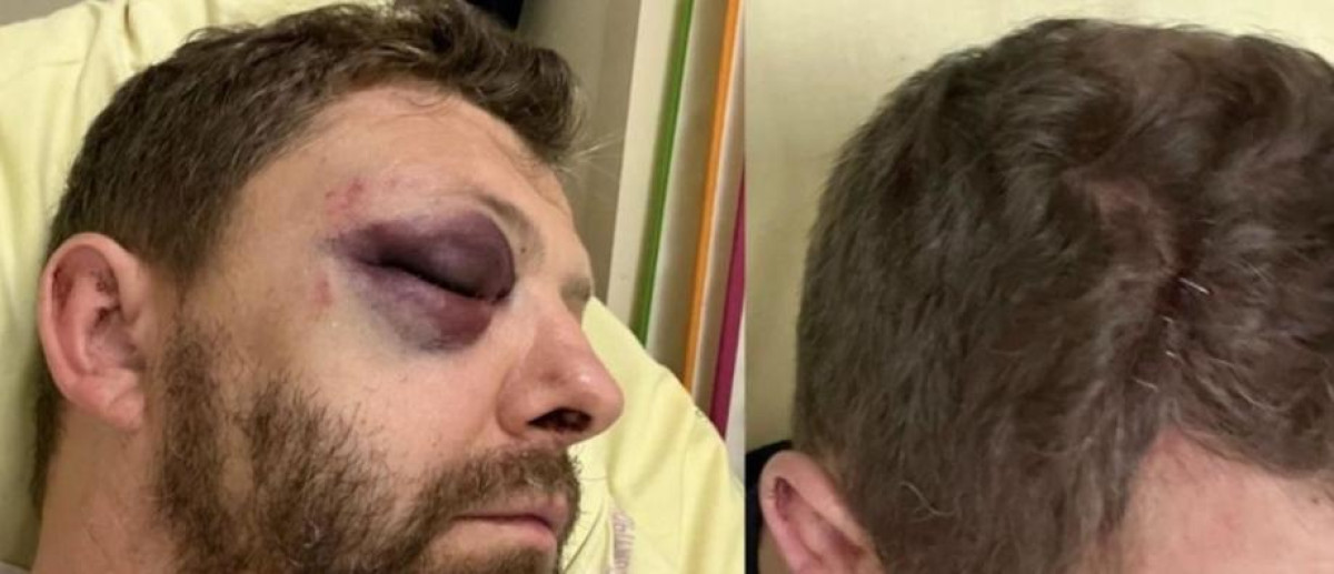 « Il pourrait perdre un œil » : l'agresseur du policier Pierre Picavet laissé libre malgré 40 jours d'ITT