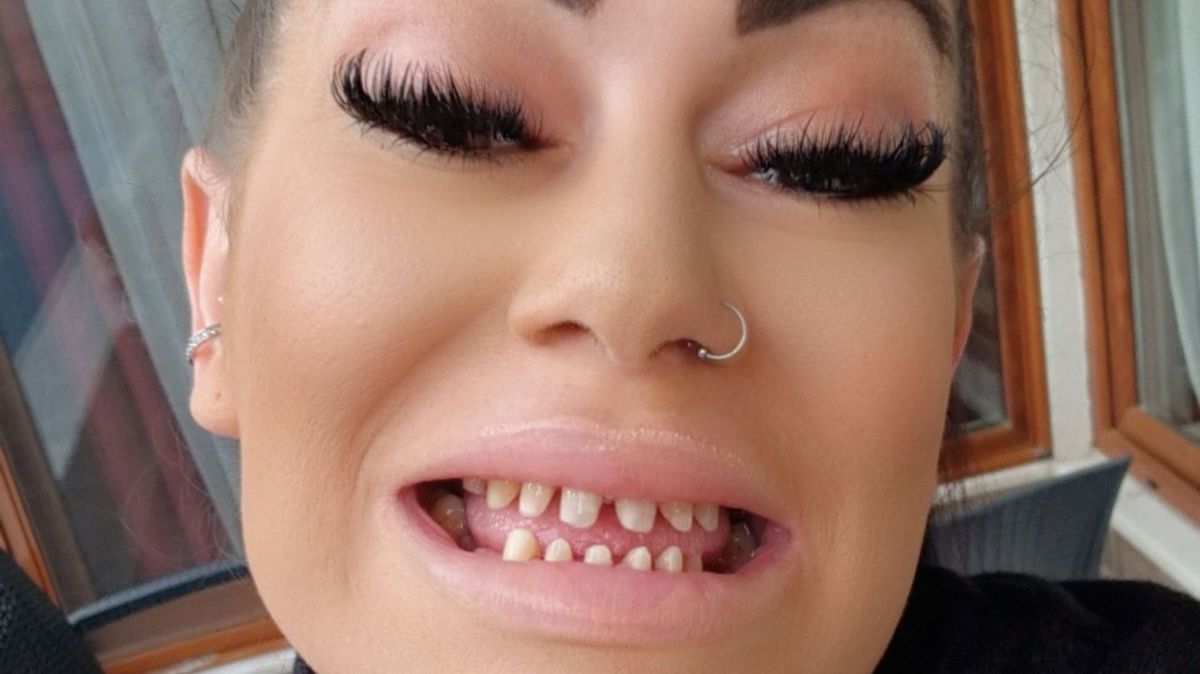 « J'ai 38 ans, je ne devrais pas perdre toutes mes dents » : le cauchemar à 18 000 £ d'une mère après un séjour dentaire en Turquie