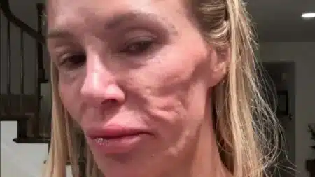 Brandi Glanville va se faire « retirer le visage » : ce que son médecin pense avoir trouvé sous sa peau