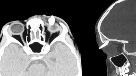 Une dent poussait dans l'orbite de cet ado de 16 ans : le cas rarissime qui a stupéfié les médecins