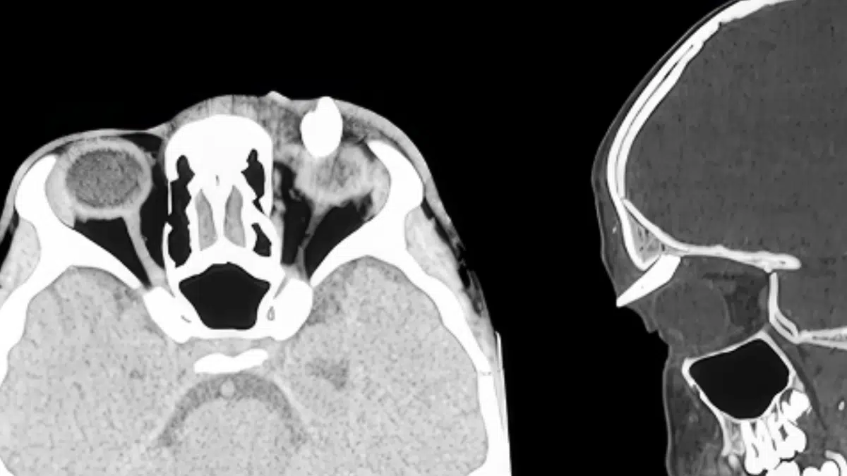 Une dent poussait dans l'orbite de cet ado de 16 ans : le cas rarissime qui a stupéfié les médecins